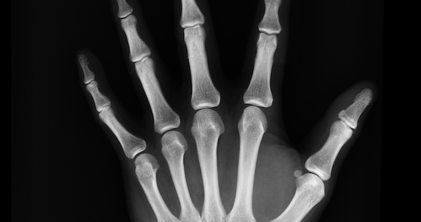 Vegans at higher risk for bone fractures