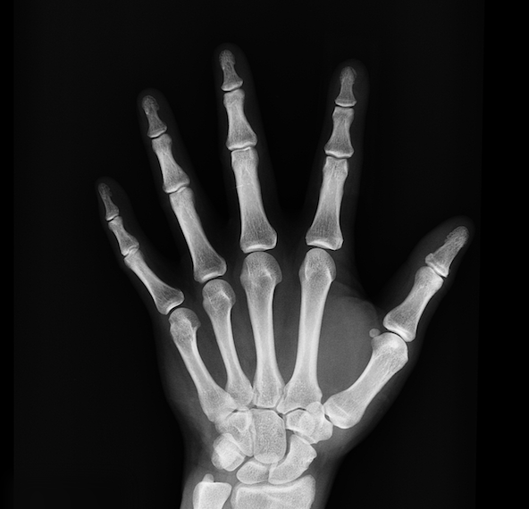 X_ray_penn_bones.original.png