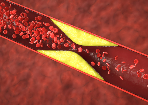 Limited - Coronary Heart Disease Prime Healthcare