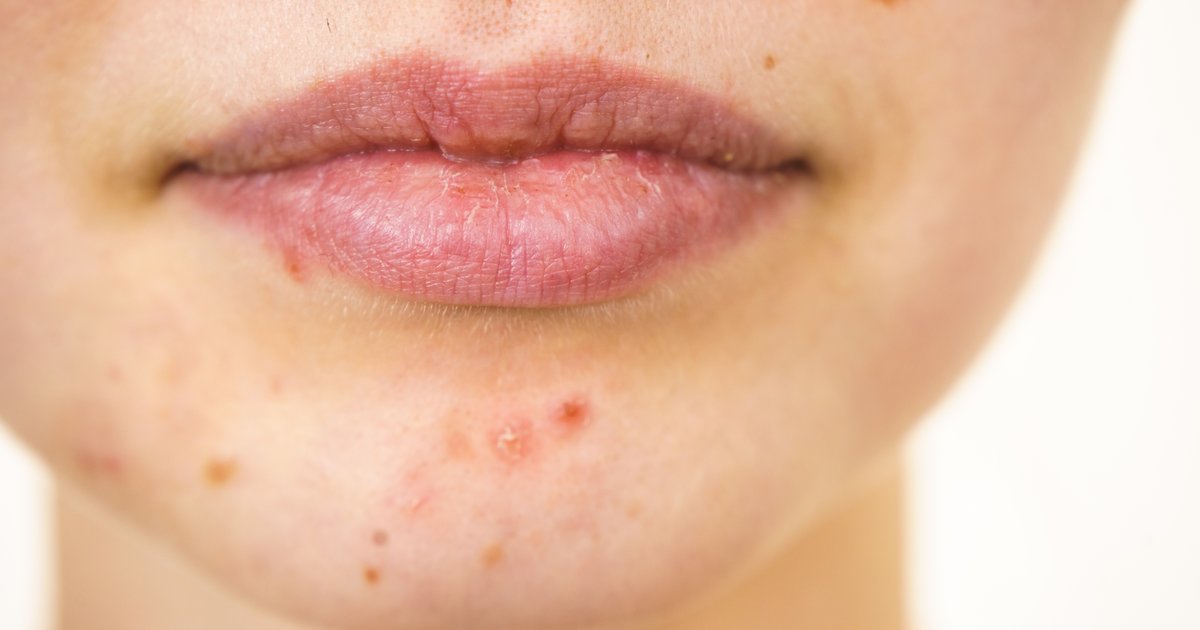 How To Use Acne: what to do To Desire