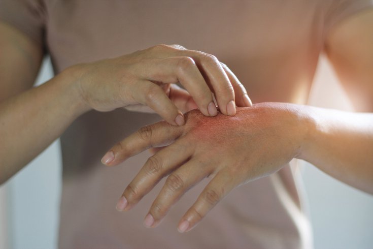 Female scratching the itch on her hand - cause of itching from skin diseases