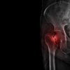 Film X-ray hip radiograph show broken hip bone