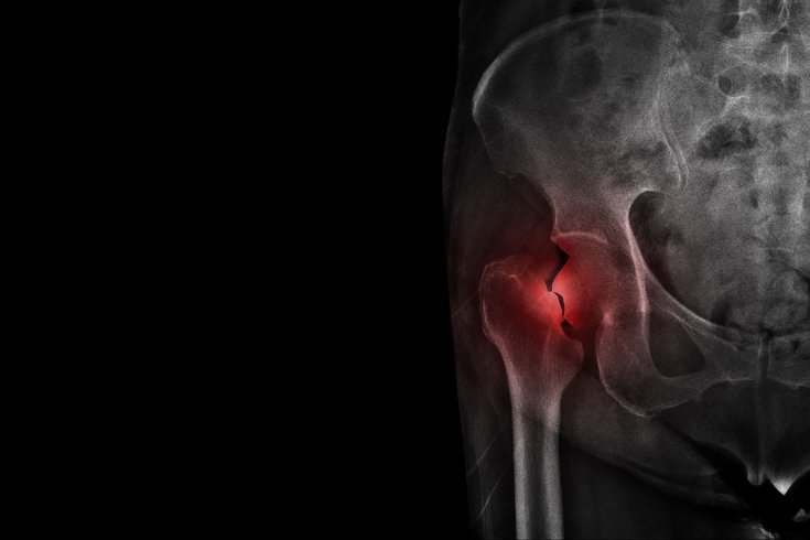 Film X-ray hip radiograph show broken hip bone