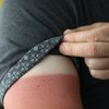 Purchased - Person with severe sunburn