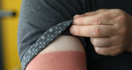 Purchased - sunburn under sleeve