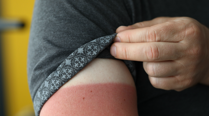 Purchased - sunburn under sleeve
