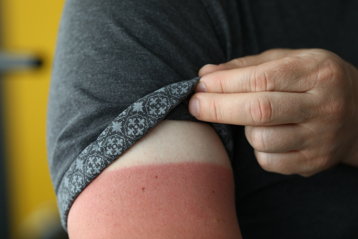 Purchased - sunburn under sleeve