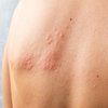Purchased - A person with shingles rash