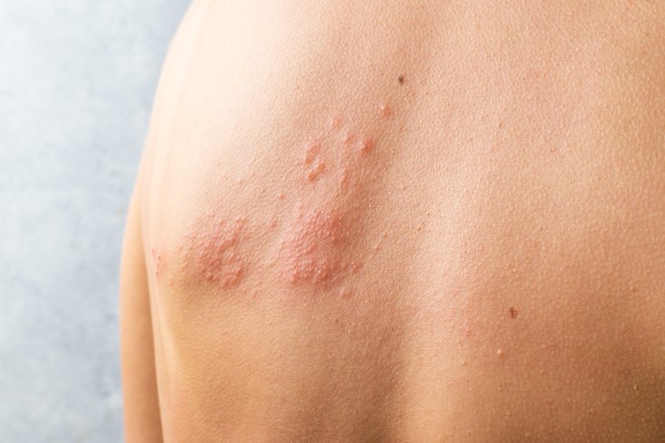 Purchased - A person with shingles rash