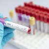 HIV Positive Blood Test