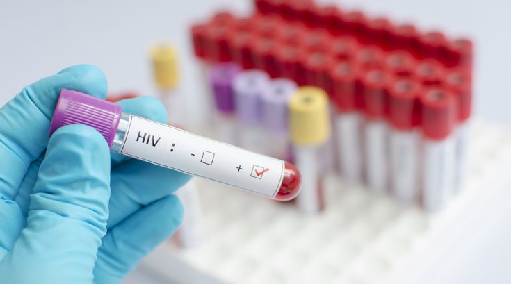 HIV Positive Blood Test