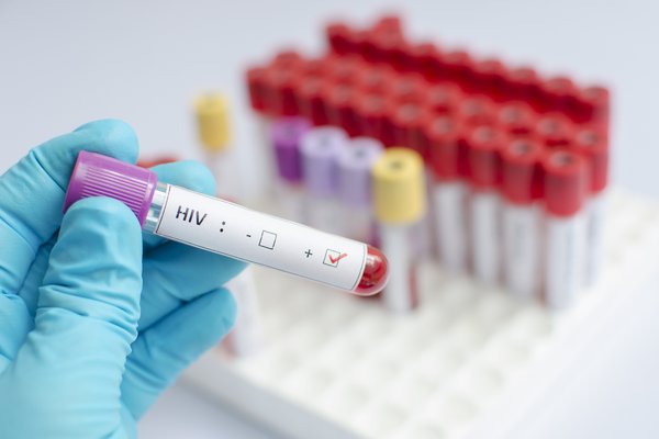 HIV Positive Blood Test
