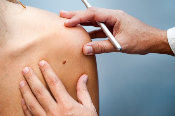 Examining a mole