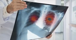 Purchased - Xray of lungs