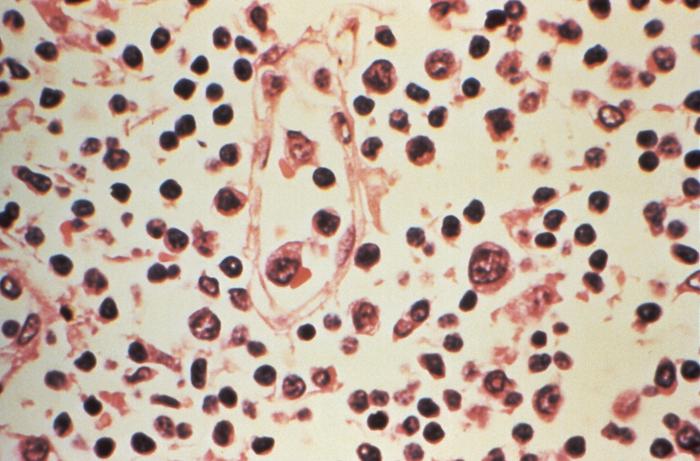 What is hantavirus, the deadly illness that has stricken a cruise ship?